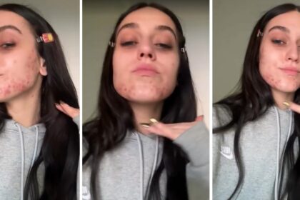 ''La mia pelle urla e chiede aiuto'': la cantante Gaia mostra lo sfogo cutaneo sul viso a causa del periodo che sta vivendo, guarda - Gossip.it