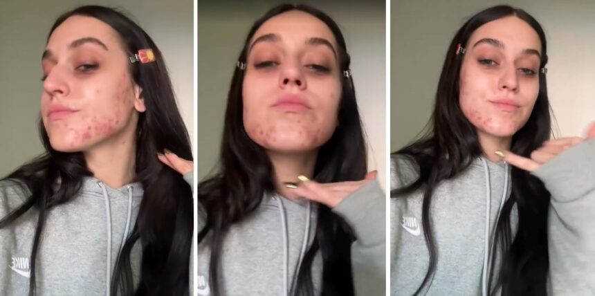''La mia pelle urla e chiede aiuto'': la cantante Gaia mostra lo sfogo cutaneo sul viso a causa del periodo che sta vivendo, guarda - Gossip.it