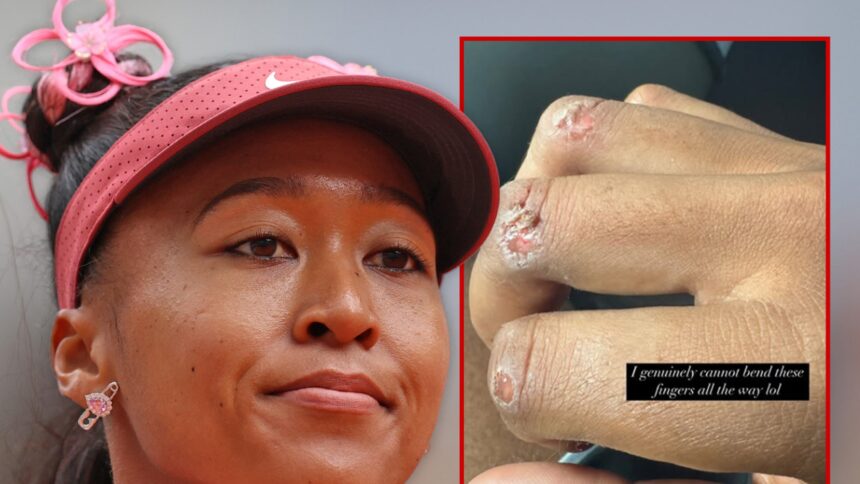 Naomi Osaka mette in mostra le vesciche nodose