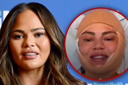 Chrissy Teigen rivela la chirurgia del viso durante il flusso live di Instagram