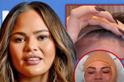Chrissy Teigen si rivolge alla faccia bendata dopo l'intervento chirurgico