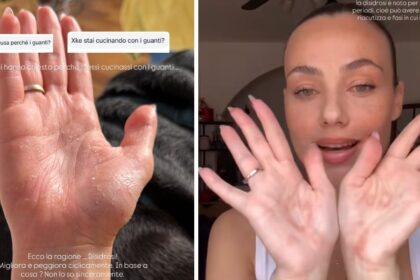 Rosalinda Cannavò mostra le mani sofferenti e svela il problema di salute che la obbliga a indossare guanti - Gossip.it