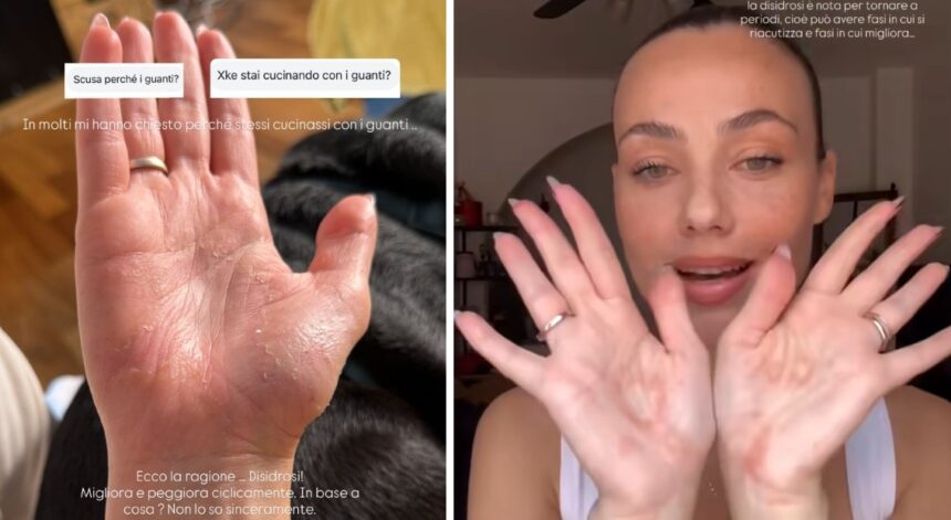 Rosalinda Cannavò mostra le mani sofferenti e svela il problema di salute che la obbliga a indossare guanti - Gossip.it
