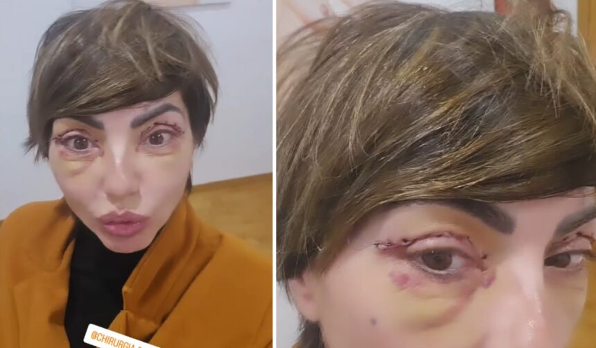 ''Ho tolto i punti'': l’ex Non è la Rai Ilaria Galassi si è sottoposta a un intervento di chirurgia estetica, ecco quale - Gossip.it