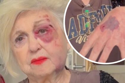 Ecchimosi e graffi: Wanna Marchi si mostra sul social ''devastata'', ecco cos’è successo - Gossip.it