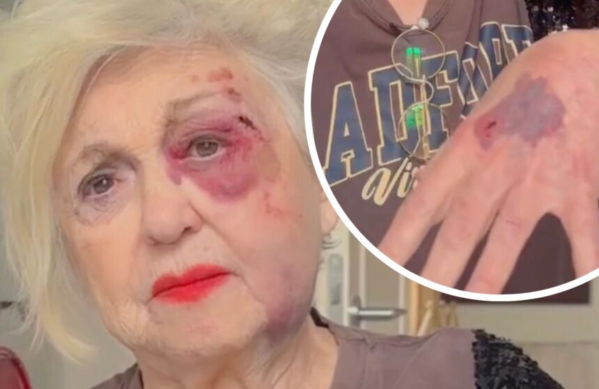 Ecchimosi e graffi: Wanna Marchi si mostra sul social ''devastata'', ecco cos’è successo - Gossip.it