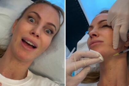 ''Io ho iniziato a 20 anni'': Taylor Mega si mostra mentre si fa il Botox e ammette di sottoporsi alle punturine da 12 anni - Gossip.it