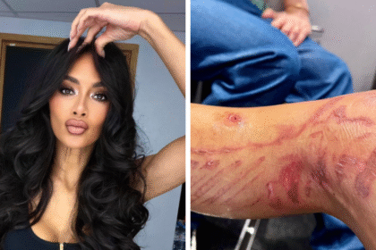 La cantante della “Pussycat Dolls” Nicole Scherzinger mostra la gamba dopo l’incidente: ustioni e vesciche, ecco cos’è successo - Gossip.it