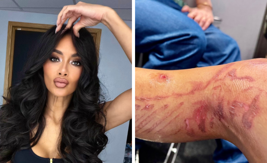 La cantante della “Pussycat Dolls” Nicole Scherzinger mostra la gamba dopo l’incidente: ustioni e vesciche, ecco cos’è successo - Gossip.it